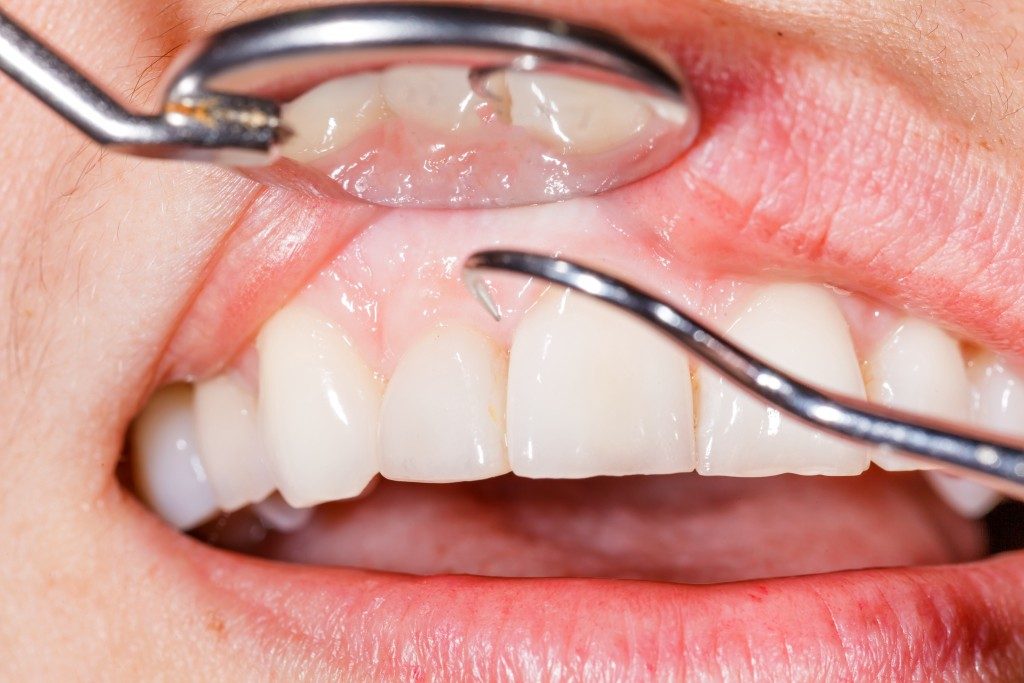 Dentist checking gums for plaque