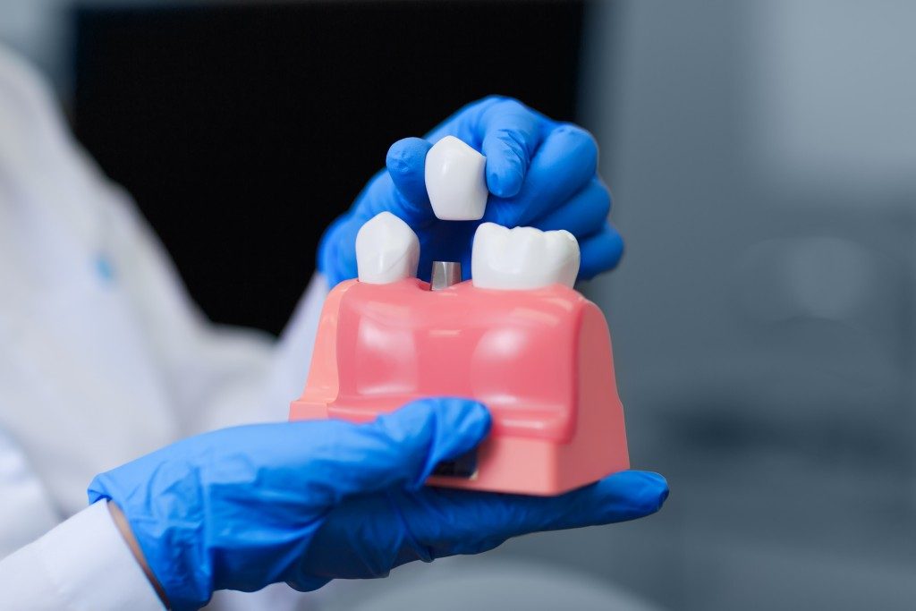 dentist holding a model of dental implant