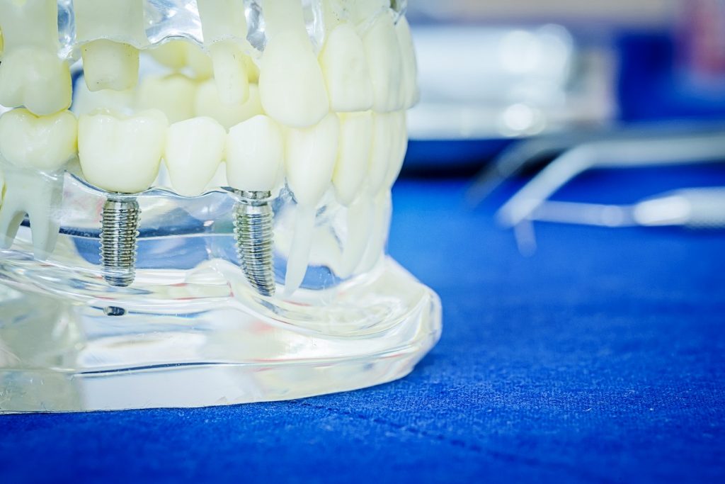 Dental implant teeth model