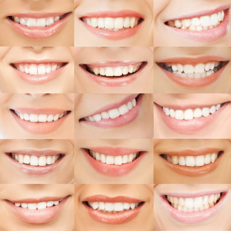 Photo collage of close-up pictures of smiles showing teeth