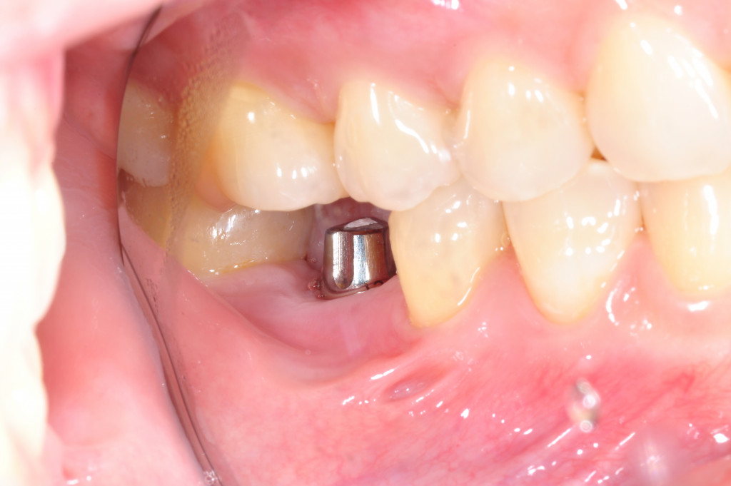 A single tooth dental implant inside a person's mouth