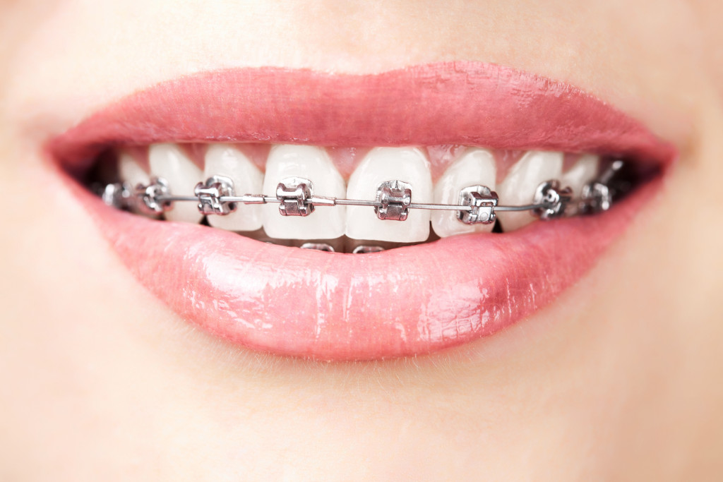 close up metal dental brace