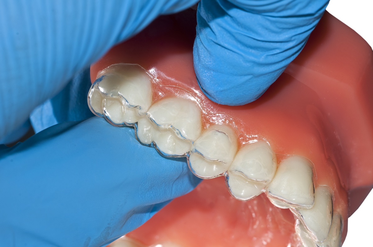 teeth model with invisalign